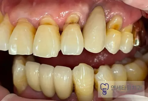 치료 전 치아 사진. 위쪽 여러 치아의 잇몸 쪽 경계 부위가 누렇게 드러나고 움푹 패여 있다