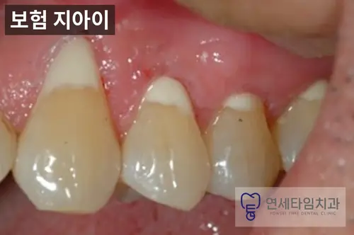 지아이(GI)로 치경부를 메운 치아 사진. 잇몸 쪽 메운 부분이 치아보다 하얗고 불투명하게 보인다