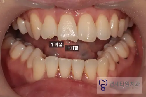 치료 전 앞니 사진. 오른쪽 위 큰앞니와 작은앞니의 끝이 깨져 있다