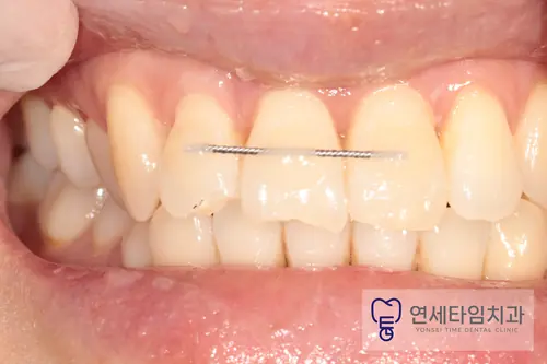 흔들리는 앞니를 옆 치아들과 함께 와이어로 고정한 모습