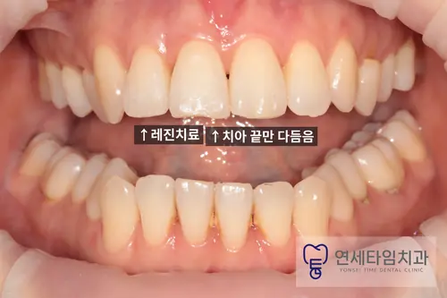 치료 후 앞니 사진. 작은앞니는 레진으로 수복하고 큰앞니는 끝을 다듬었다